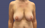 Breast Lift w/ Augmentation 1 Before